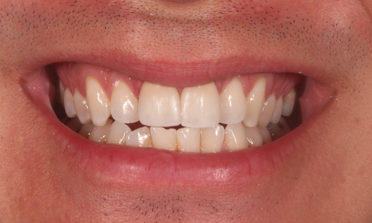 After (dental trauma)