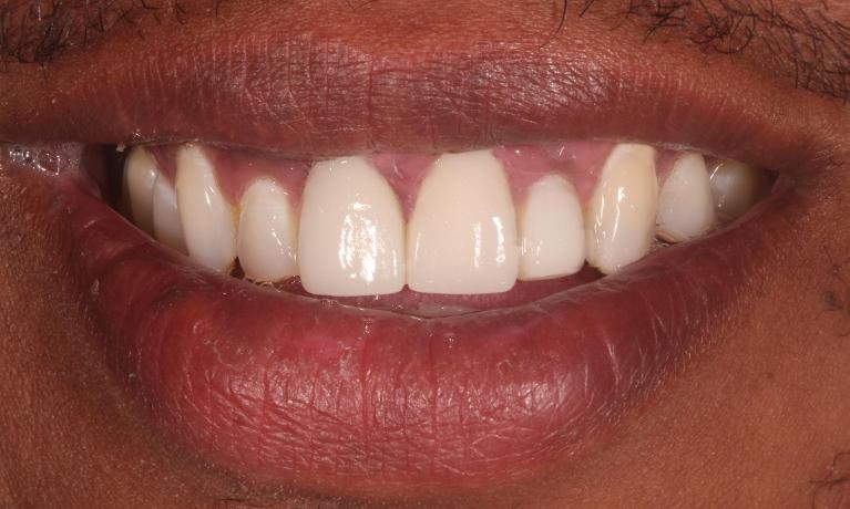 After (bonding and crowns)