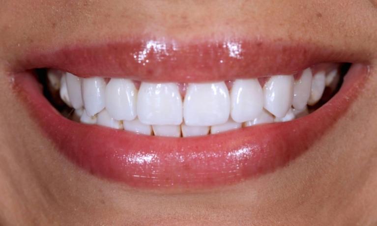 After (dental crowns)