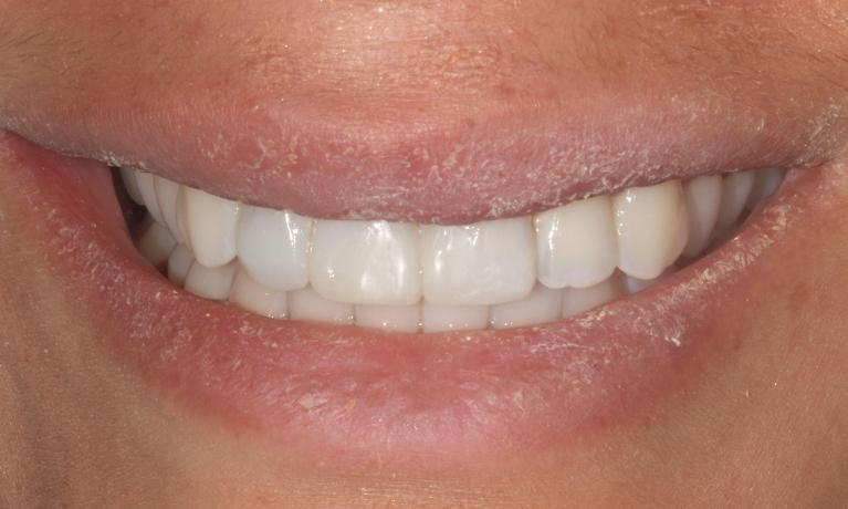 After (dental crowns)
