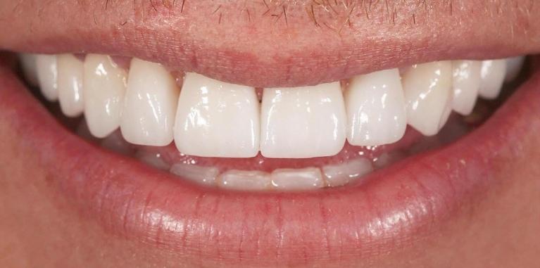 After (veneers)