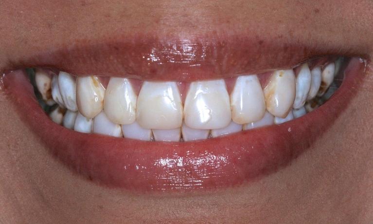 Before (dental crowns)