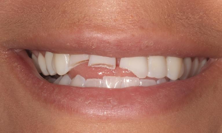 Before (dental crowns)